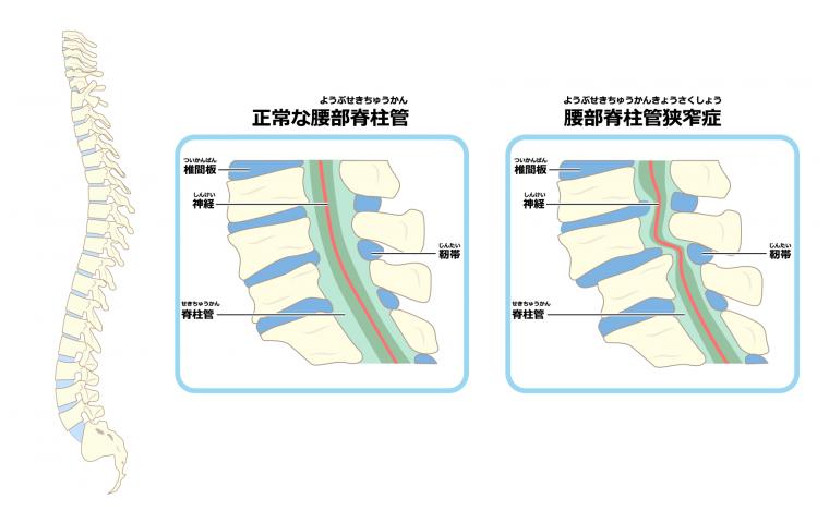 脊柱管狭窄症って???