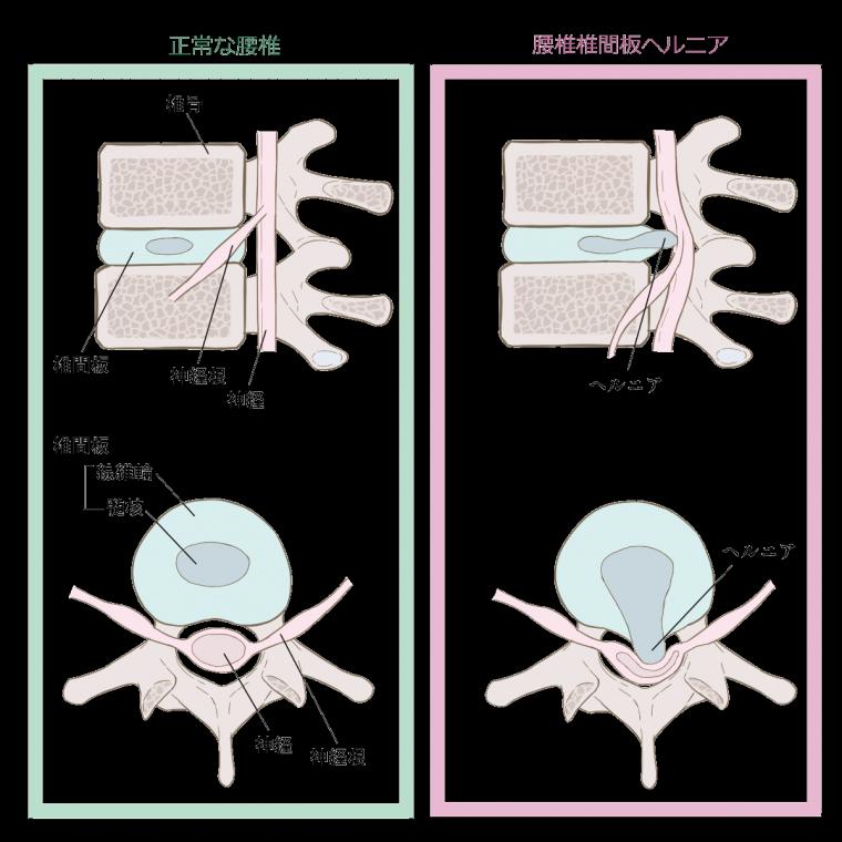 腰のヘルニアって??