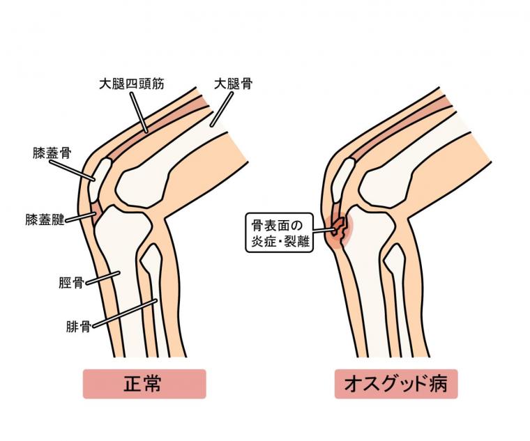オスグット病