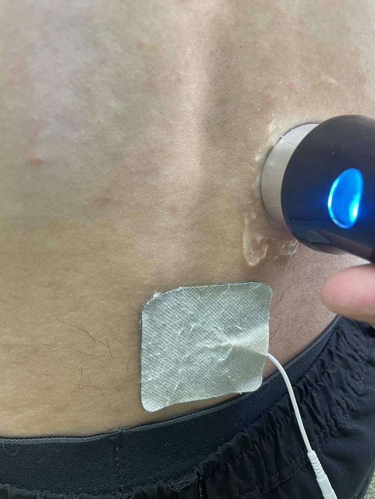 【急性腰痛(ギックリ腰)】症状改善レポート