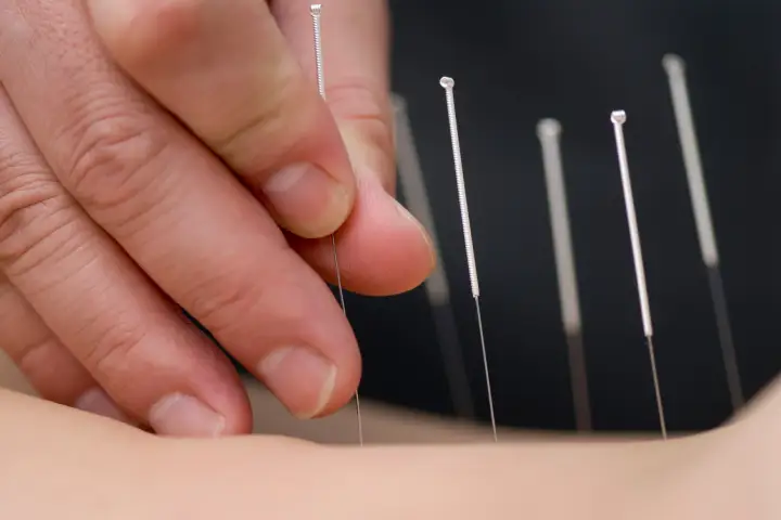 鍼灸の効果を実感できるのはいつから？基本的なタイミングの目安