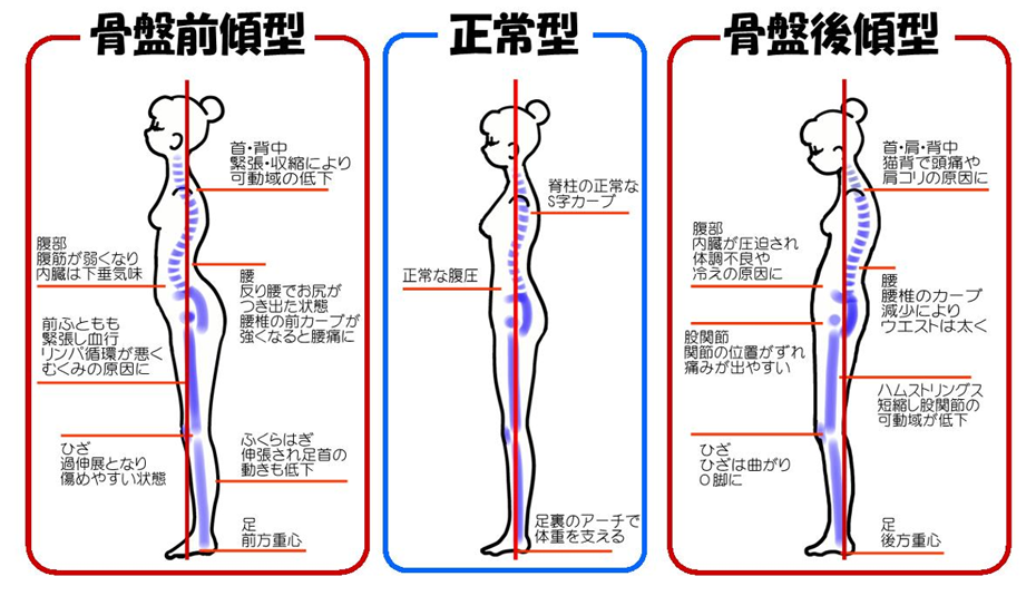 骨盤前傾型／正常型／骨盤後傾型